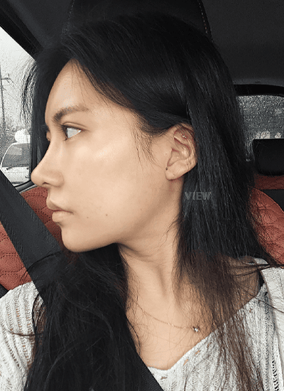 面部轮廓、鼻部整形、眼部整形手术二个月后侧面