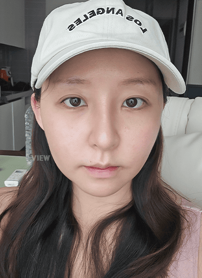 眼部整形、鼻部整形、轮廓整形手术二周后正面