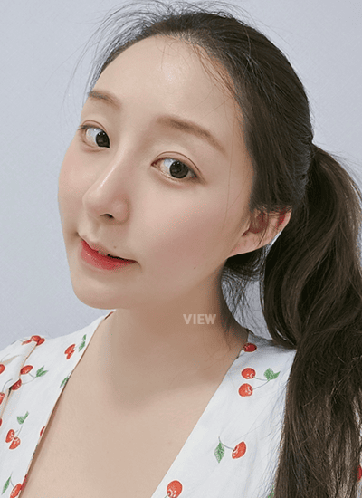 眼部整形、鼻部整形、轮廓整形手术二个月后