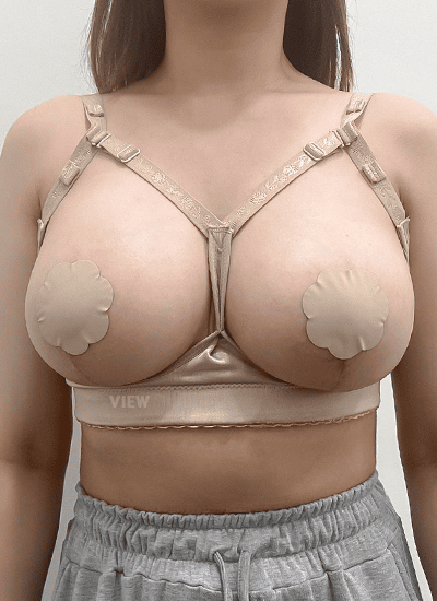 隆胸手术、吸脂手术14天后正面