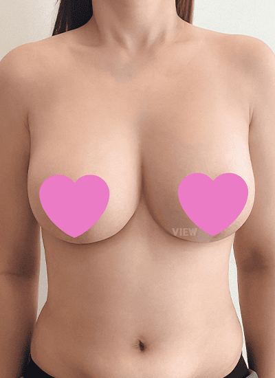 隆胸手术、吸脂手术二个月后正面