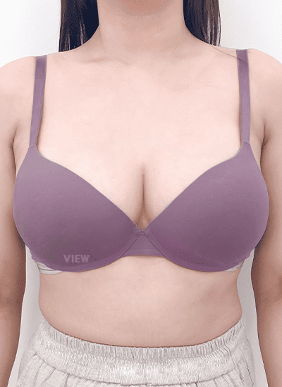 隆胸手术、吸脂手术四个月后正面