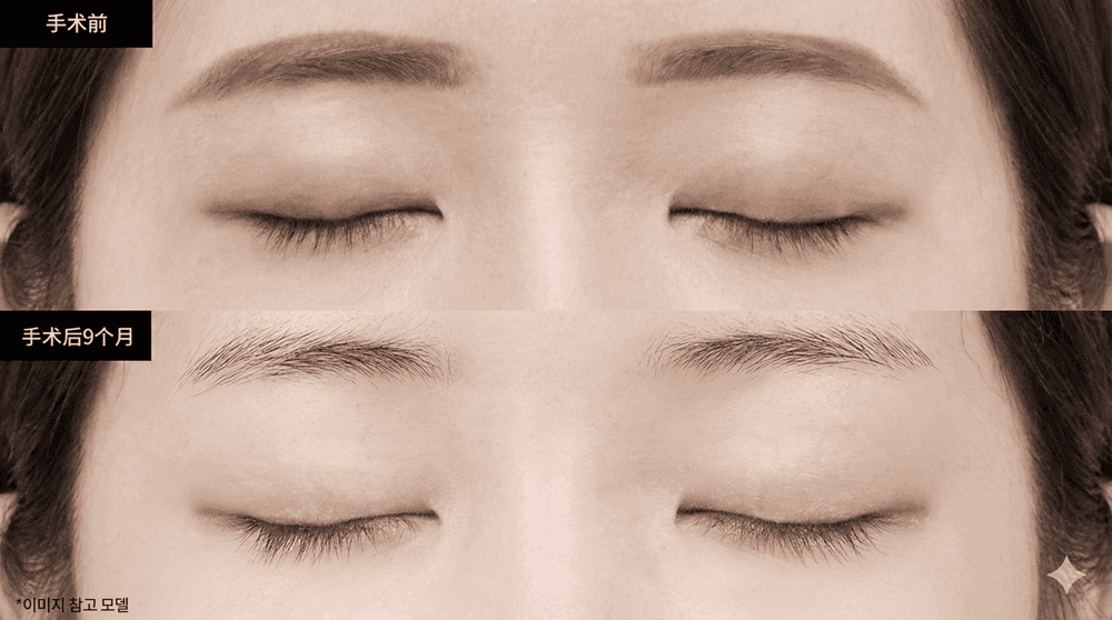 必妩双眼皮术前术后
