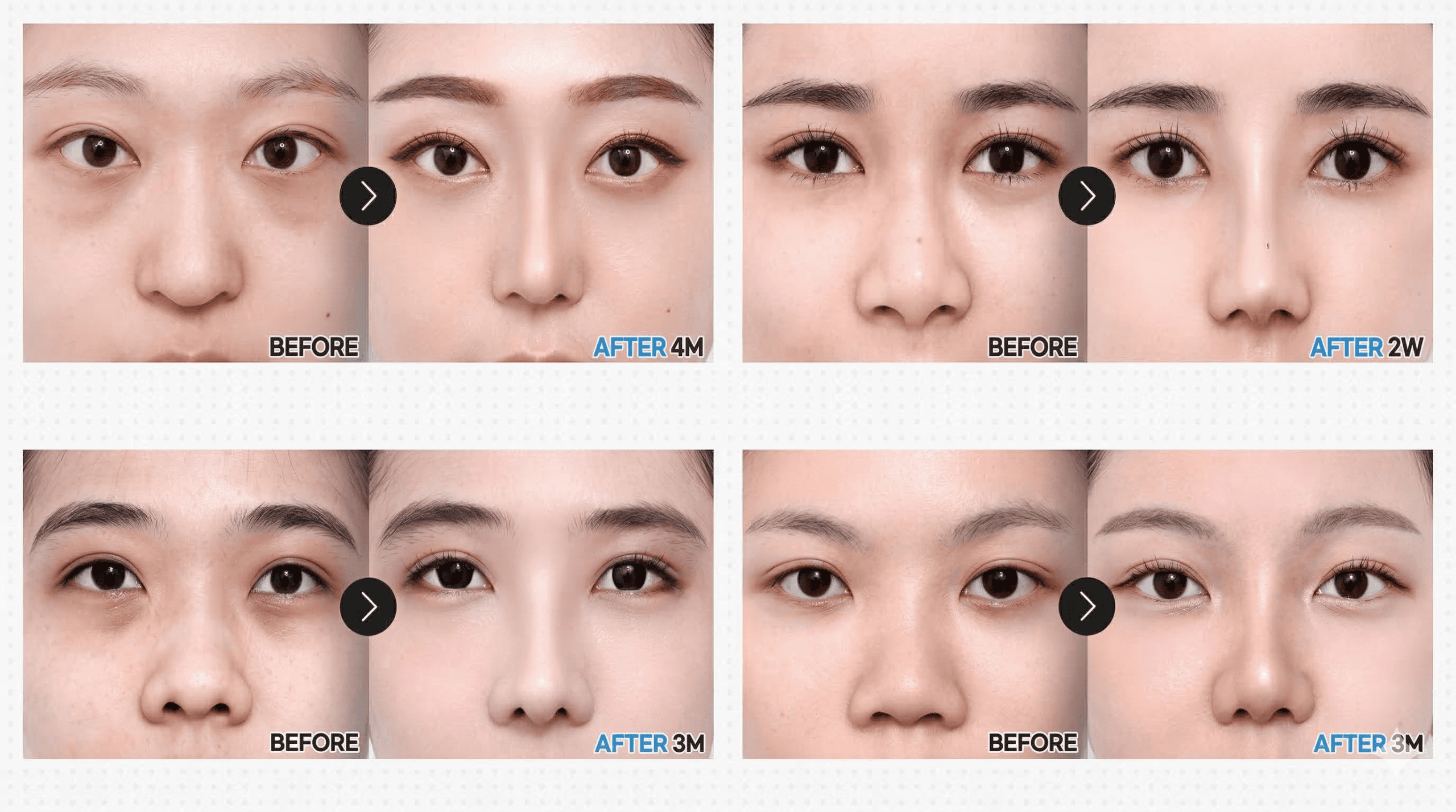 韩国必妩整形医院蒜头鼻整形