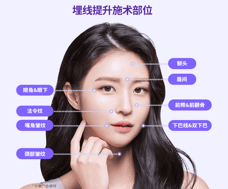 韩国埋线提升