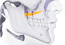 View韩国双鄂手术专利技术：调整的是颌面，升级的是整张脸！