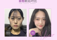 View韩国凸嘴手术+轮廓手术案例：深度解析为什么脸型美感大于五官！
