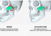 View韩国面部轮廓手术案例：外轮廓才是拿捏颜值的关键！