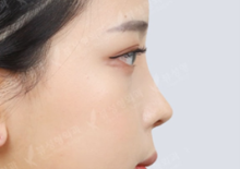 View韩国鼻子修复手术案例曝光！这样的鼻型你给打几分？